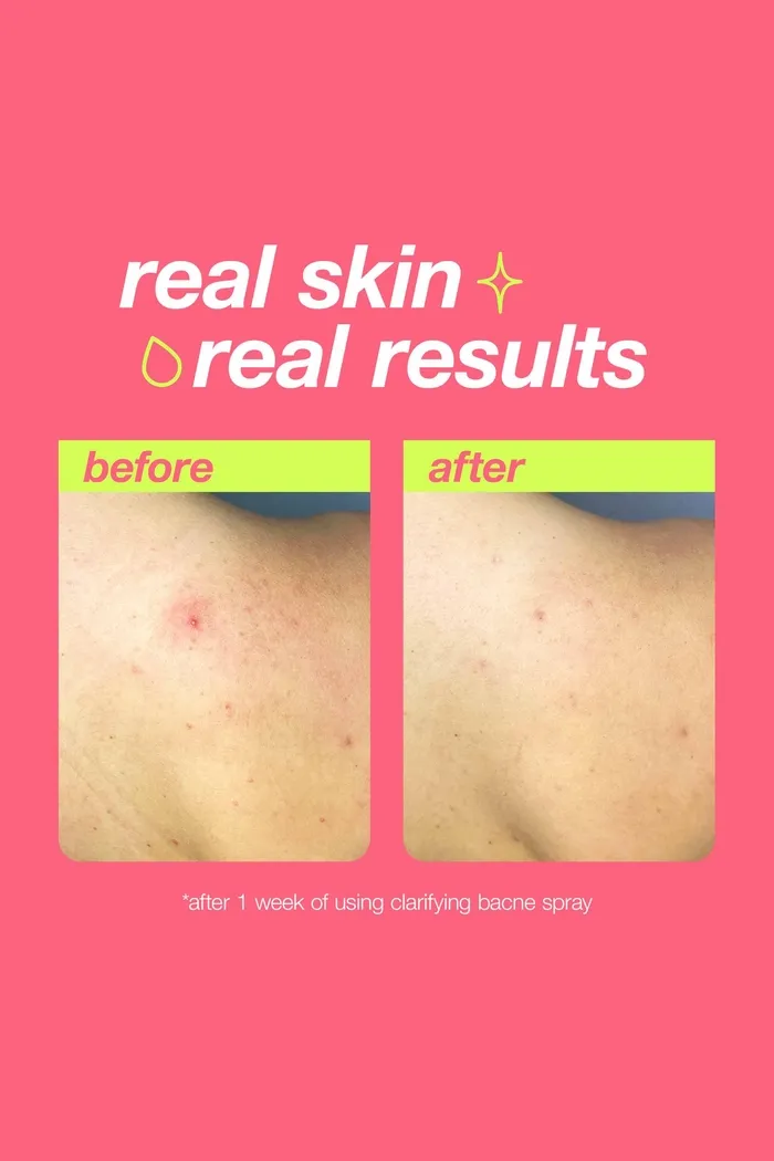 очищающий спрей от прыщей на спине