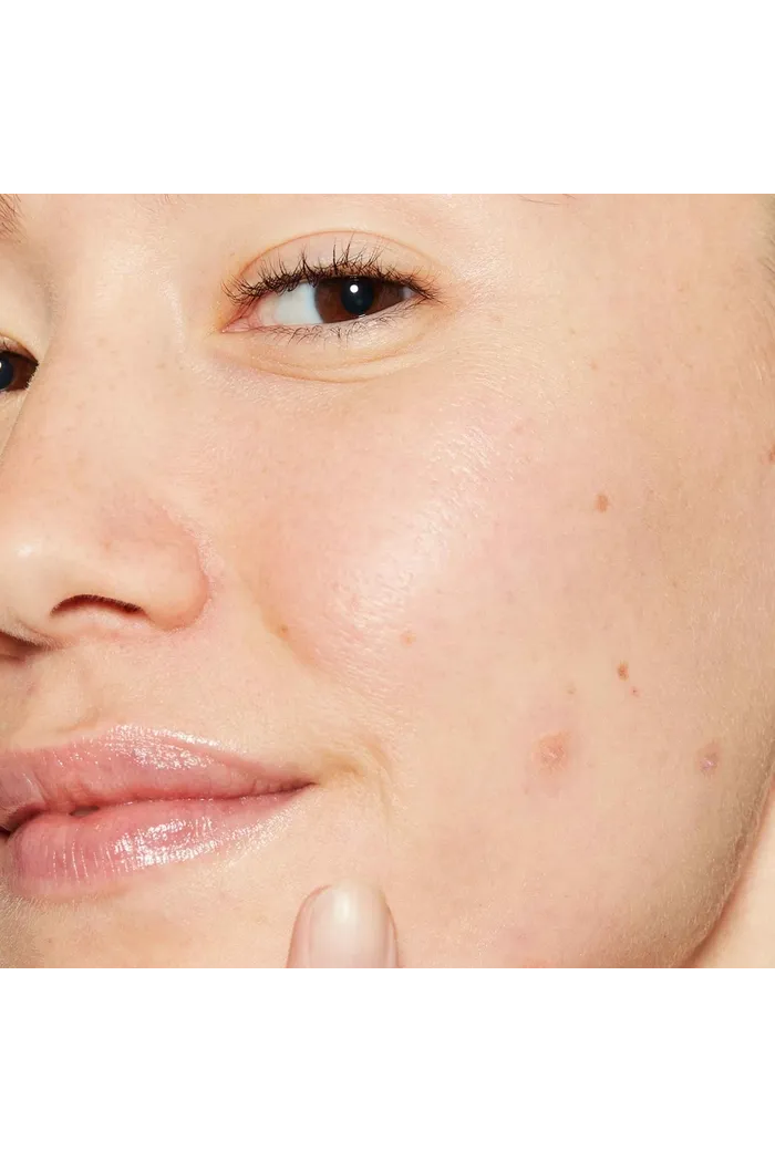 невидимый жидкий пластырь от глубоких прыщей