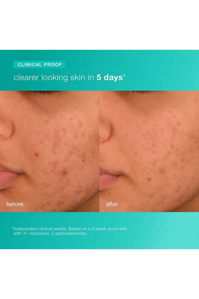 Увлажняющий крем Acne Biotic для проблемной кожи